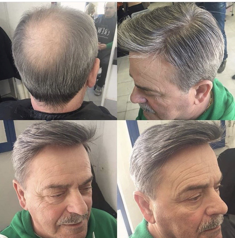 Close-up of natural-looking hair weave blended into thinning hairline