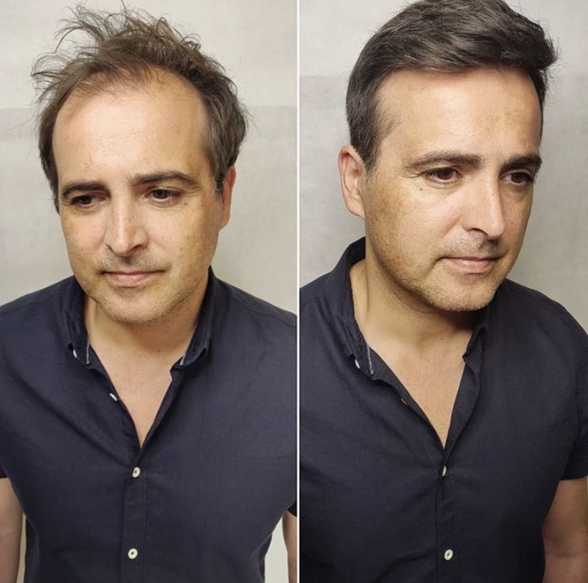Before-and-after comparison of non-surgical hair loss solution on crown